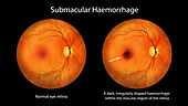 Submacular haemorrhage on the retina, illustration