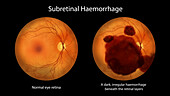 Subretinal haemorrhage on the retina, illustration