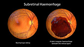 Subretinal haemorrhage on the retina, illustration