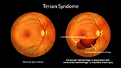 Intraocular haemorrhage in Terson syndrome, illustration