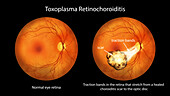 Toxoplasma retinochoroiditis, illustration