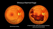 Vitreous haemorrhage, illustration