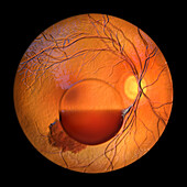 Intraocular haemorrhage in Terson syndrome, illustration