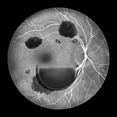 Intraocular haemorrhage in Terson syndrome, illustration