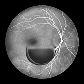 Valsava retinopathy, illustration