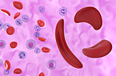 Sickle cell anaemia, illustration