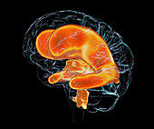 Enlarged ventricles of a child's brain, illustration