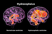 Enlarged and normal brain ventricles, illustration