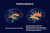 Enlarged and normal brain lateral ventricles, illustration