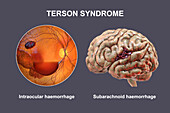 Terson syndrome, illustration