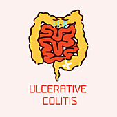 Ulcerative colitis, conceptual illustration