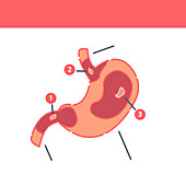 Peptic ulcer, conceptual illustration