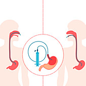 Enteral feeding tubes, conceptual illustration