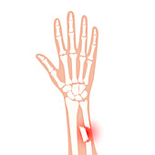 Fractured arm, illustration