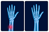 Fractured and healthy wrists, illustration