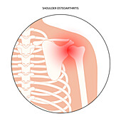 Shoulder pain, conceptual illustration