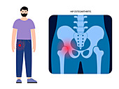 Hip pain and arthritis, illustration