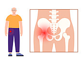 Hip pain, conceptual illustration