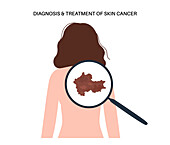 Skin cancer, illustration