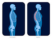 Healthy spine and scoliosis, illustration