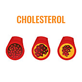 Atherosclerosis, conceptual illustration