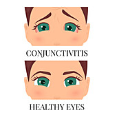 Conjunctivitis, conceptual illustration