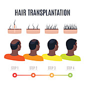 Hair transplantation, conceptual illustration