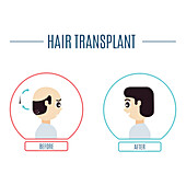 Hair transplantation, conceptual illustration