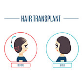 Hair transplantation, conceptual illustration