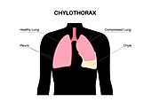 Chylothorax, illustration