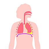 Chylothorax, illustration