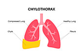 Chylothorax, illustration