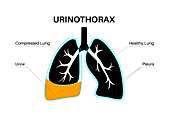 Urinothorax, illustration