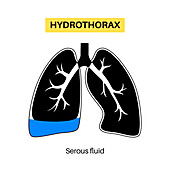 Hydrothorax, illustration