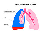 Haemopneumothorax, illustration