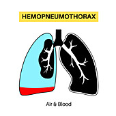 Haemopneumothorax, illustration