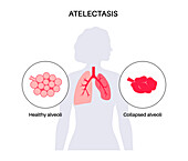 Atelectasis, illustration