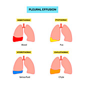 Pleural effusion, illustration
