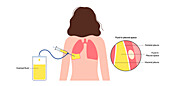 Thoracentesis medical procedure, illustration