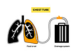 Chest tube catheter, illustration