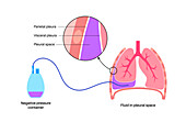 Tunnelled pleural catheter, illustration