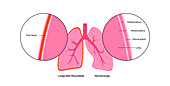 Pleurodesis medical procedure, illustration