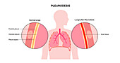 Pleurodesis medical procedure, illustration