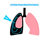 Pneumothorax, illustration