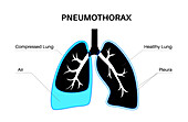 Pneumothorax, illustration