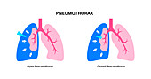 Pneumothorax, illustration