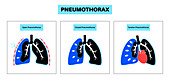 Pneumothorax, illustration