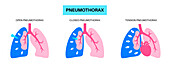 Pneumothorax, illustration