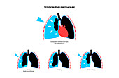 Tension pneumothorax, illustration
