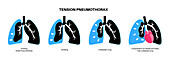 Tension pneumothorax, illustration